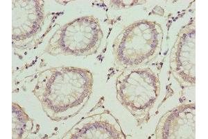 Immunohistochemistry of paraffin-embedded human colon cancer using ABIN7163613 at dilution of 1:100 (PLA2G7 Antikörper  (AA 49-441))