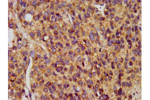 IHC image of ABIN7159750 diluted at 1:400 and staining in paraffin-embedded human glioma performed on a Leica BondTM system. (MAP1A Antikörper  (AA 1979-2168))