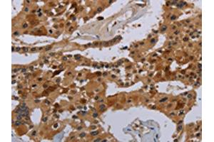 The image on the left is immunohistochemistry of paraffin-embedded Human prostate cancer tissue using ABIN7190333(COX18 Antibody) at dilution 1/20, on the right is treated with synthetic peptide. (COX18 Antikörper)
