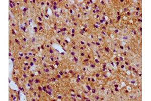 IHC image of ABIN7171107 diluted at 1:300 and staining in paraffin-embedded human glioma performed on a Leica BondTM system. (SV2C Antikörper  (AA 459-524))