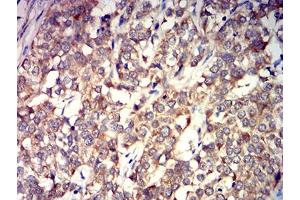 Immunohistochemical analysis of paraffin-embedded bladder cancer tissues using GRIK4 mouse mAb with DAB staining. (GRIK4 Antikörper  (AA 21-166))