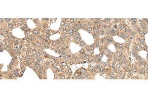 Immunohistochemistry of paraffin-embedded Human liver cancer tissue using APC Polyclonal Antibody at dilution of 1:45(x200) (APC Antikörper)