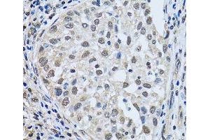 Immunohistochemistry of paraffin-embedded Human lung cancer using LSM4 Polyclonal Antibody at dilution of 1:100 (40x lens). (LSM4 Antikörper)