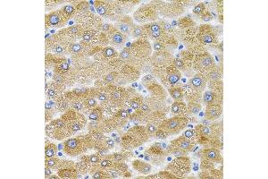 Immunohistochemistry of paraffin-embedded human liver damage using Mitofusin 2 antibody (ABIN6128301, ABIN6143801, ABIN6143804 and ABIN6217669) (40x lens). (MFN2 Antikörper  (AA 687-757))