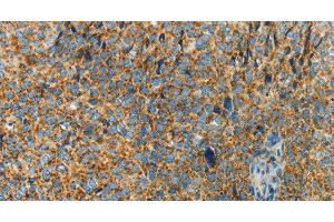 Immunohistochemistry of paraffin-embedded Human cervical cancer using BCAT2 Polyclonal Antibody at dilution of 1:70 (BCAT2 Antikörper)
