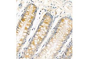 Immunohistochemistry of paraffin embedded human colon cancer using AnnexinA13 (ABIN7073061) at dilution of 1:1500 (400x lens) (Annexin A13 Antikörper)