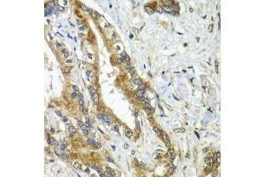 Immunohistochemistry of paraffin-embedded human liver cancer using CDC16 antibody (ABIN5974330) at dilution of 1/100 (40x lens). (CDC16 Antikörper)