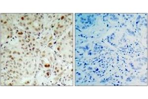 Immunohistochemistry analysis of paraffin-embedded human breast carcinoma, using Retinoblastoma (Phospho-Ser807) Antibody.