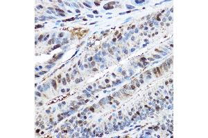 Immunohistochemistry of paraffin-embedded human colon carcinoma using CDK2 Rabbit pAb  at dilution of 1:200 (40x lens). (CDK2 Antikörper)