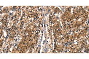 Immunohistochemistry of paraffin-embedded Human gastric cancer tissue using DDX4 Polyclonal Antibody at dilution 1:40 (DDX4 Antikörper)