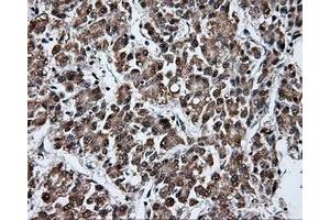 Immunohistochemical staining of paraffin-embedded Carcinoma of liver tissue using anti-FAHD2A mouse monoclonal antibody. (FAHD2A Antikörper)