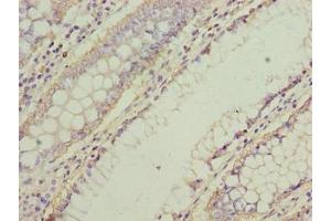 Immunohistochemistry of paraffin-embedded human colon cancer using ABIN7161338 at dilution of 1:100 (NMUR1 Antikörper  (AA 360-426))