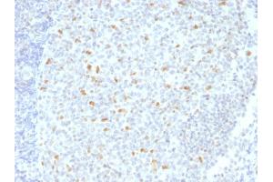 Formalin-fixed, paraffin-embedded human Hodgkin's Lymphoma stained with BCL-6 Mouse Monoclonal Antibody (BCL6/1526). (BCL6 Antikörper  (AA 256-389))
