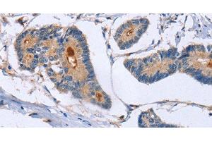 Immunohistochemistry of paraffin-embedded Human colon cancer using GMFG Polyclonal Antibody at dilution of 1:50 (GMFG Antikörper)