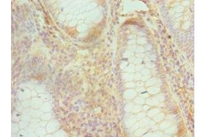 Immunohistochemistry of paraffin-embedded human colon cancer using ABIN7148748 at dilution of 1:100 (Cullin 1 Antikörper  (AA 500-776))