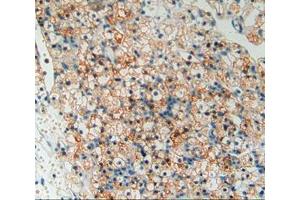 Used in DAB staining on fromalin fixed paraffin- embedded kidney cancer tissue