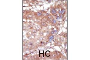 Formalin-fixed and paraffin-embedded human cancer tissue reacted with the primary antibody, which was peroxidase-conjugated to the secondary antibody, followed by AEC staining. (TNK2 Antikörper  (C-Term))