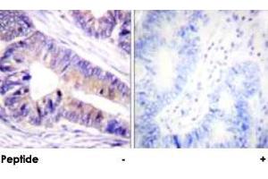 Immunohistochemical analysis of paraffin-embedded human colon carcinoma tissue using YWHAZ polyclonal antibody . (14-3-3 zeta Antikörper)