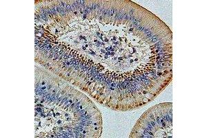 Immunohistochemical analysis of IFI44 staining in human colon cancer formalin fixed paraffin embedded tissue section. (IFI44 Antikörper)