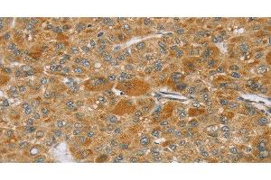 Immunohistochemistry of paraffin-embedded Human liver cancer using TP53I11 Polyclonal Antibody at dilution of 1:40 (TP53I11 Antikörper)