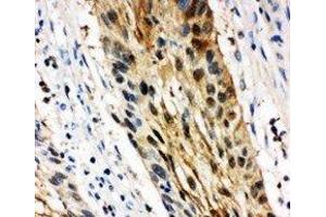 Anti-14-3-3 sigma antibody, IHC(P) IHC(P): Human Oesophagus Squama Cancer Tissue