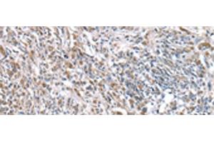 Immunohistochemistry of paraffin-embedded Human prost ate cancer tissue using RNF115 Polyclonal Antibody at dilution of 1:45(x200) (RNF115 Antikörper)