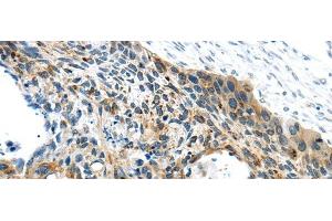 Immunohistochemistry of paraffin-embedded Human esophagus cancer using VAMP2 Polyclonal Antibody at dilution of 1/40 (VAMP2 Antikörper)