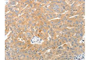 The image on the left is immunohistochemistry of paraffin-embedded Human ovarian cancer tissue using (TEP1 Antibody) at dilution 1/50, on the right is treated with synthetic peptide. (TEP1 Antikörper)