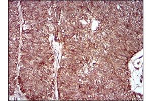 Immunohistochemical analysis of paraffin-embedded ovarian cancer tissues using MMEL1 mouse mAb with DAB staining. (MMEL1 Antikörper  (AA 1-107))