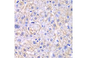 Immunohistochemistry of paraffin-embedded human liver injury using EHHADH antibody (ABIN6292474) at dilution of 1:100 (40x lens). (EHHADH Antikörper)