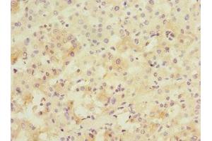 Immunohistochemistry of paraffin-embedded human liver cancer using ABIN7165942 at dilution of 1:100