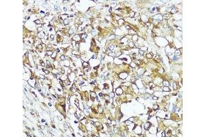 Immunohistochemistry of paraffin-embedded Human liver cancer using MLKL Polyclonal Antibody at dilution of 1:200 (40x lens). (MLKL Antikörper)