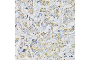 Immunohistochemistry of paraffin-embedded human breast cancer using J antibody (ABIN1678787, ABIN3018048, ABIN3018049 and ABIN6220343) at dilution of 1:100 (40x lens). (ATP5J Antikörper  (AA 1-108))