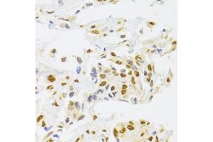 Immunohistochemistry of paraffin-embedded human breast cancer using hnRNP  Antibody (ABIN6128029, ABIN6141896, ABIN6141899 and ABIN6223388) at dilution of 1:100 (40x lens). (HNRNPA1 Antikörper  (AA 1-372))