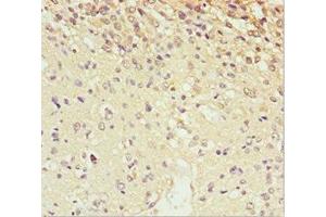 Immunohistochemistry of paraffin-embedded human glioma using ABIN7168663 at dilution of 1:100 (SCRN2 Antikörper  (AA 176-425))