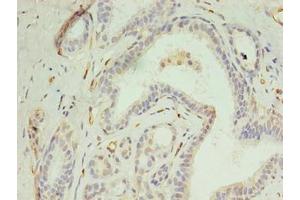 Immunohistochemistry of paraffin-embedded human breast cancer using ABIN7150021 at dilution of 1:100 (DIP2A Antikörper  (AA 1-300))