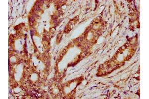 IHC image of ABIN7169246 diluted at 1:600 and staining in paraffin-embedded human colon cancer performed on a Leica BondTM system. (PPP2R2B Antikörper  (Regulatory Subunit B))