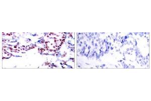 Immunohistochemical analysis of paraffin- embedded human breast carcinoma tissue using ATF-2 (Ab-71or 53) antibody (E021031). (ATF2 Antikörper)