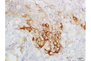 Formalin-fixed and paraffin embedded human esophageal carcinoma labeled with Rabbit Anti-CK7 Polyclonal Antibody, Unconjugated  at 1:200 followed by conjugation to the secondary antibody and DAB staining (Cytokeratin 7 Antikörper  (AA 251-350))