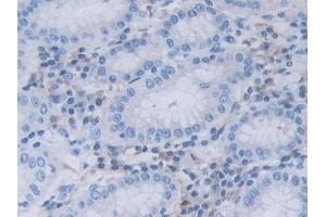 DAB staining on IHC-P; Samples: Human Stomach cancer Tissue (RNASEL Antikörper  (AA 358-583))
