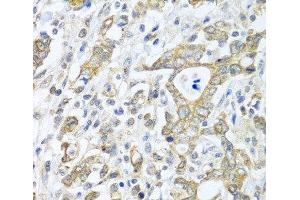 Immunohistochemistry of paraffin-embedded Human gastric cancer using TICAM1 Polyclonal Antibody at dilution of 1:100 (40x lens). (TICAM1 Antikörper)