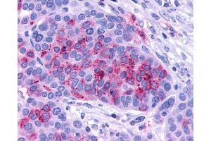Anti-ADCYAP1R1 / PAC1 Receptor antibody IHC of human Ovary, Carcinoma. (ADCYAP1R1 Antikörper  (C-Term))