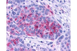 Anti-ADCYAP1R1 / PAC1 Receptor antibody IHC of human Ovary, Carcinoma.
