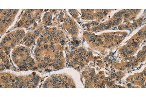 Immunohistochemistry of paraffin-embedded Human breast cancer tissue using CTNNBIP1 Polyclonal Antibody at dilution 1:30 (CTNNBIP1 Antikörper)