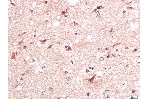 Formalin-fixed and paraffin embedded human brain glioma labeled with Anti-Torc1 (Ser151) Polyclonal Antibody, Unconjugated  at 1:200 followed by conjugation to the secondary antibody and DAB staining. (CRTC1 Antikörper  (pSer151))