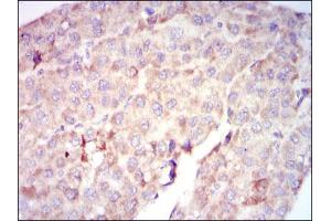 Immunohistochemical analysis of paraffin-embedded liver cancer tissues using RAF1 mouse mAb with DAB staining. (RAF1 Antikörper)
