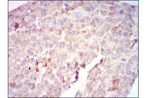 Immunohistochemical analysis of paraffin-embedded liver cancer tissues using RAF1 mouse mAb with DAB staining.