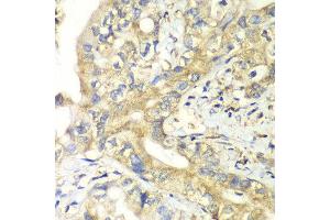 Immunohistochemistry of paraffin-embedded human liver cancer using TIMM17A antibody at dilution of 1:100 (x40 lens). (TIMM17A Antikörper)