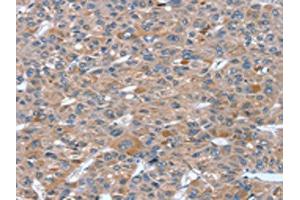 The image on the left is immunohistochemistry of paraffin-embedded Human liver cancer tissue using ABIN7130819(RASAL1 Antibody) at dilution 1/20, on the right is treated with fusion protein. (RASAL1 Antikörper)