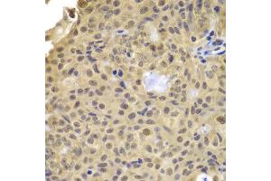 Immunohistochemistry of paraffin-embedded human well-differentiated squamous skin carcinoma using CCNA2 antibody at dilution of 1:100 (x400 lens). (Cyclin A Antikörper)